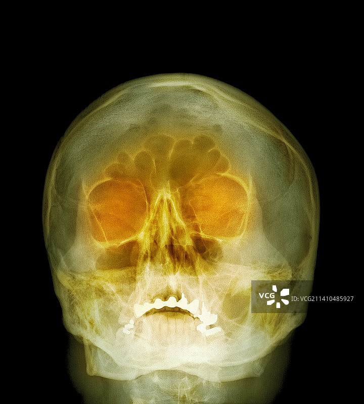 猎枪伤，X光图片素材