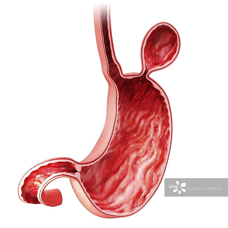 含疝气的人类胃部医学插图图片素材
