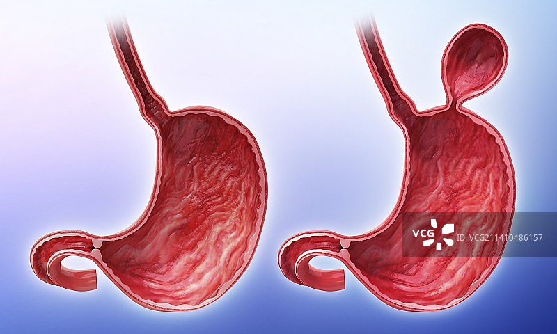 含疝气的人类胃部医学插图图片素材