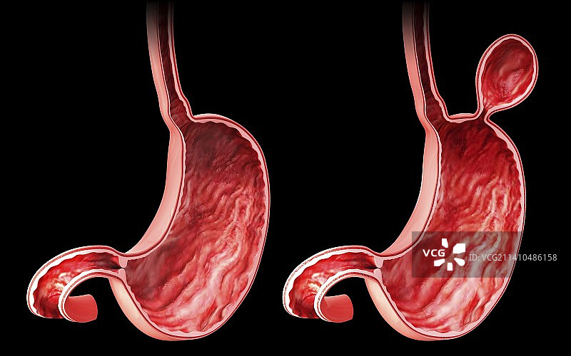 含疝气的人类胃部医学插图图片素材