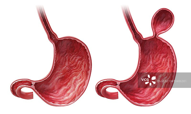 含疝气的人类胃部医学插图图片素材