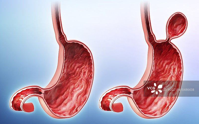 含疝气的人类胃部医学插图图片素材