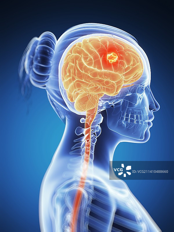 脑肿瘤艺术图图片素材