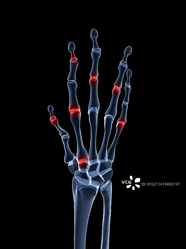关节炎手部医学插画图片素材