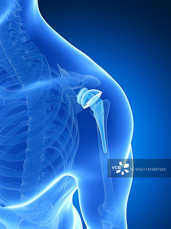 人工肩关节置换术插画图片素材