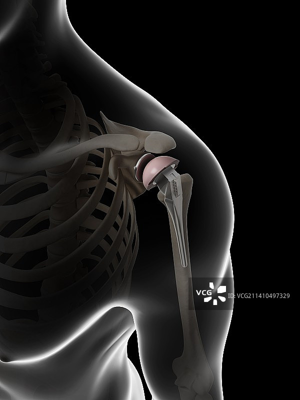 人工肩关节置换术插画图片素材