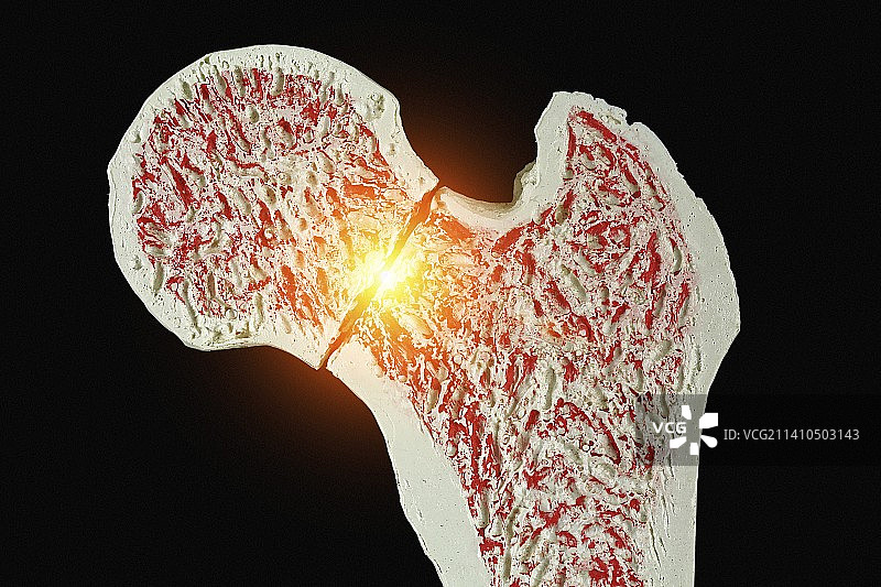 髋部骨折图片素材