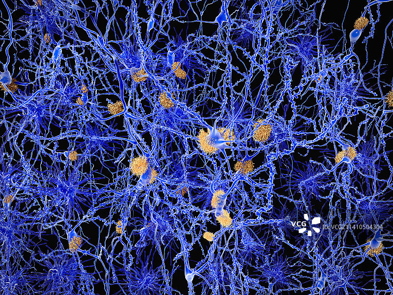 阿尔茨海默病插图图片素材