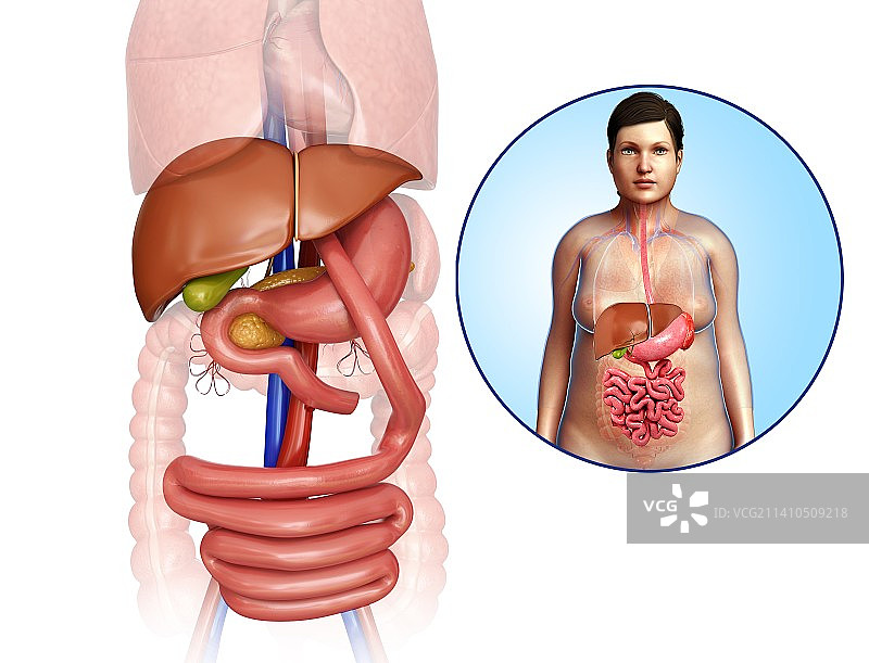 胃旁路手术示意图图片素材