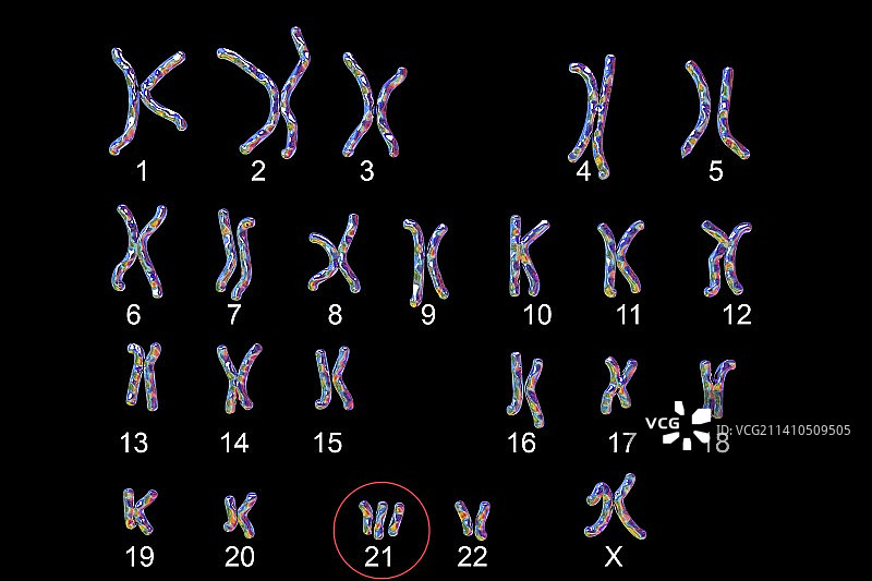 唐氏综合征核型图图片素材