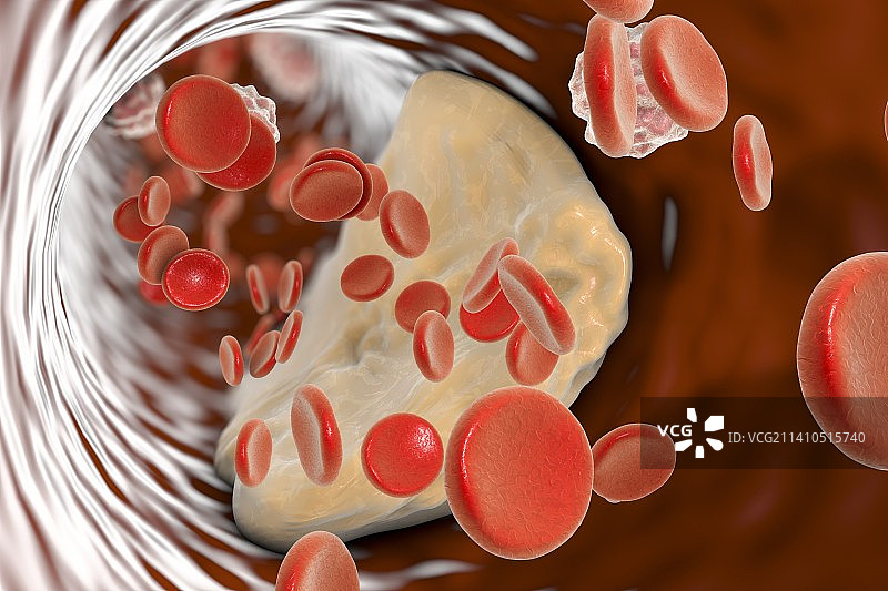 动脉粥样硬化斑块，图示图片素材
