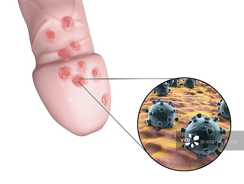 疱疹病毒与病变插画图片素材