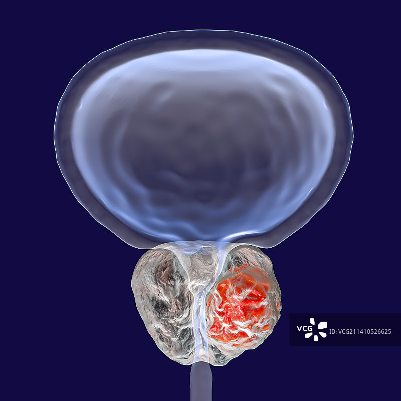 前列腺癌插画图片素材