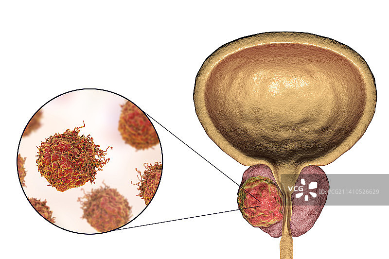 前列腺癌插画图片素材