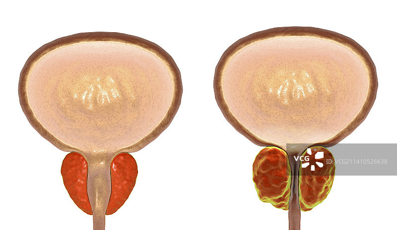 健康的 prostate 和良性前列腺增生插图图片素材