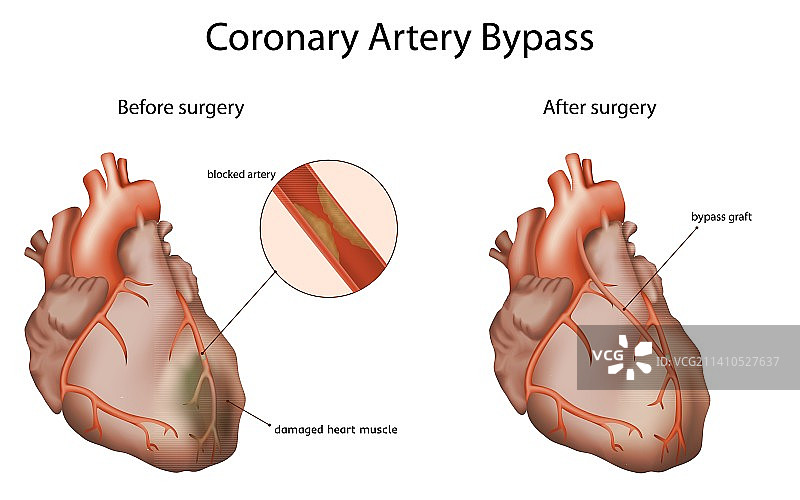 冠状动脉搭桥术图示图片素材