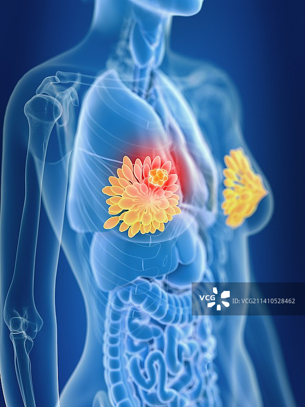 女性乳腺癌插画图片素材