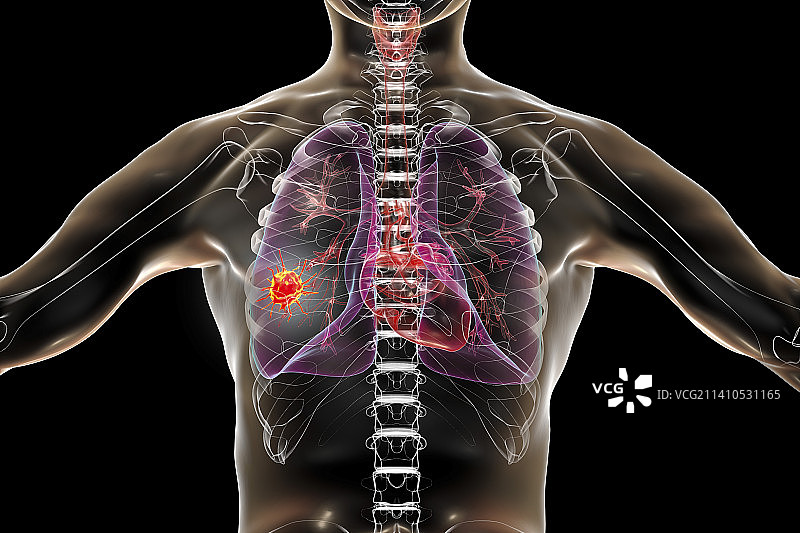 肺癌概念图图片素材