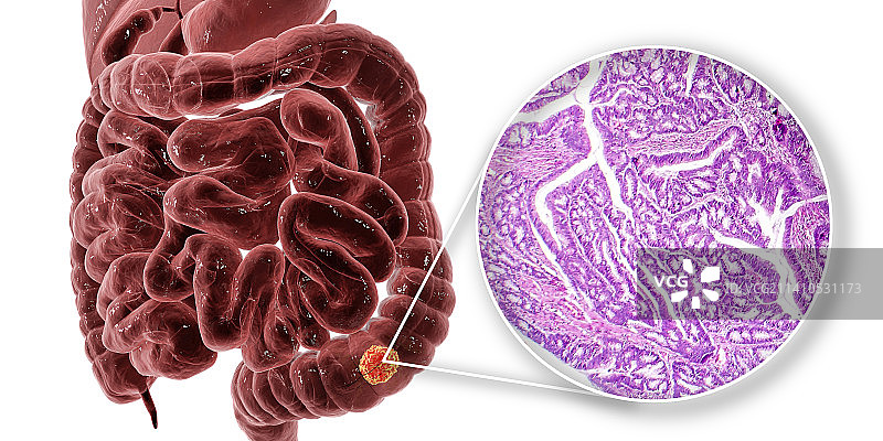 结肠癌合成图图片素材