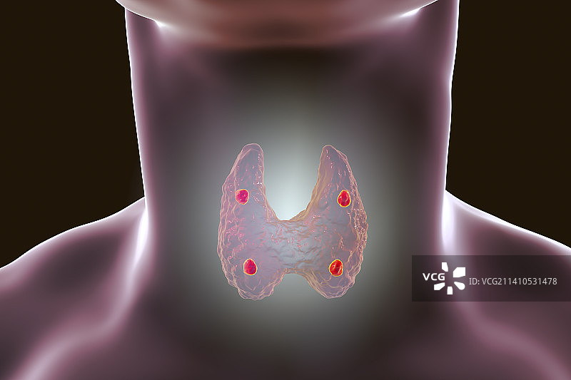 甲状旁腺图示图片素材