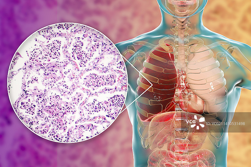 大叶性肺炎，图示和光学显微镜照片图片素材