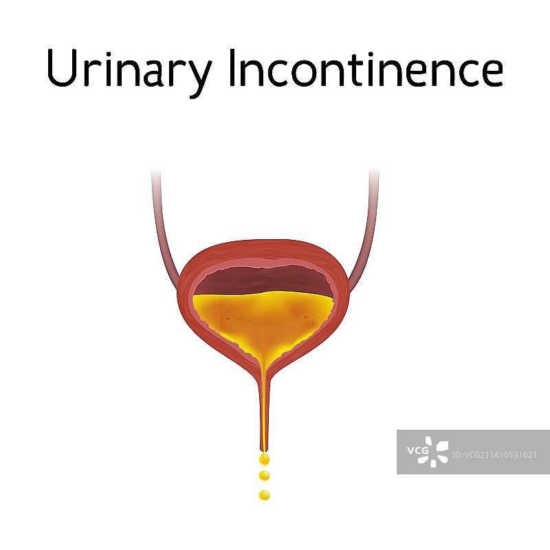 尿失禁插图图片素材