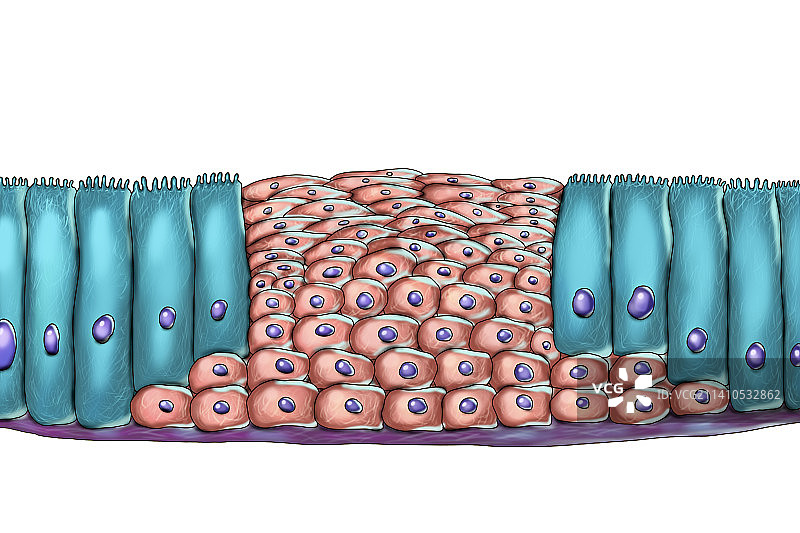 上皮化生，图示图片素材