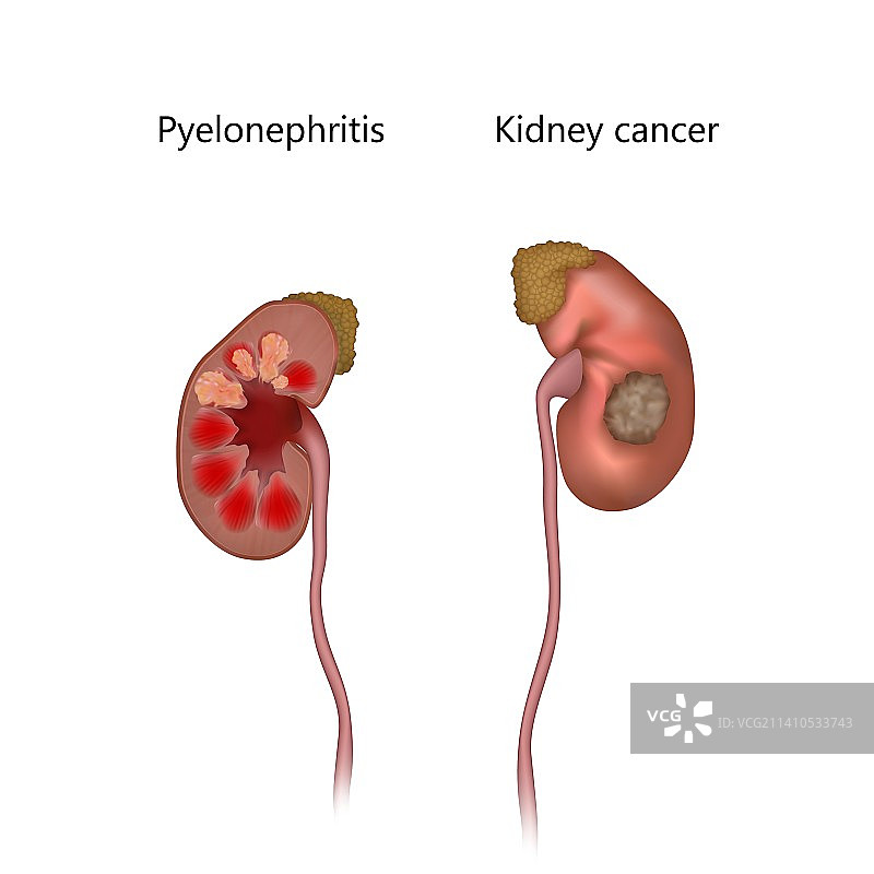 肾盂肾炎和肾癌，图示图片素材