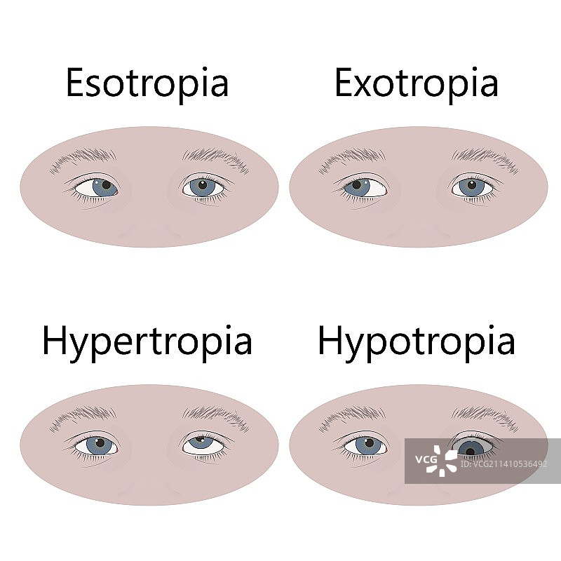 儿童斜视类型图示图片素材
