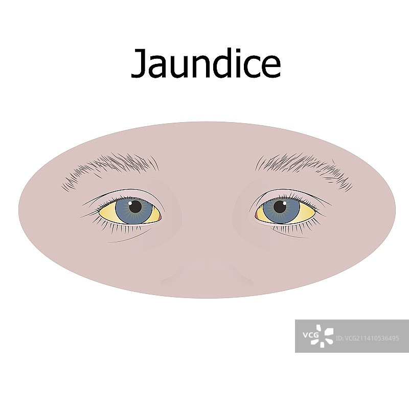黄疸眼睛插画图片素材
