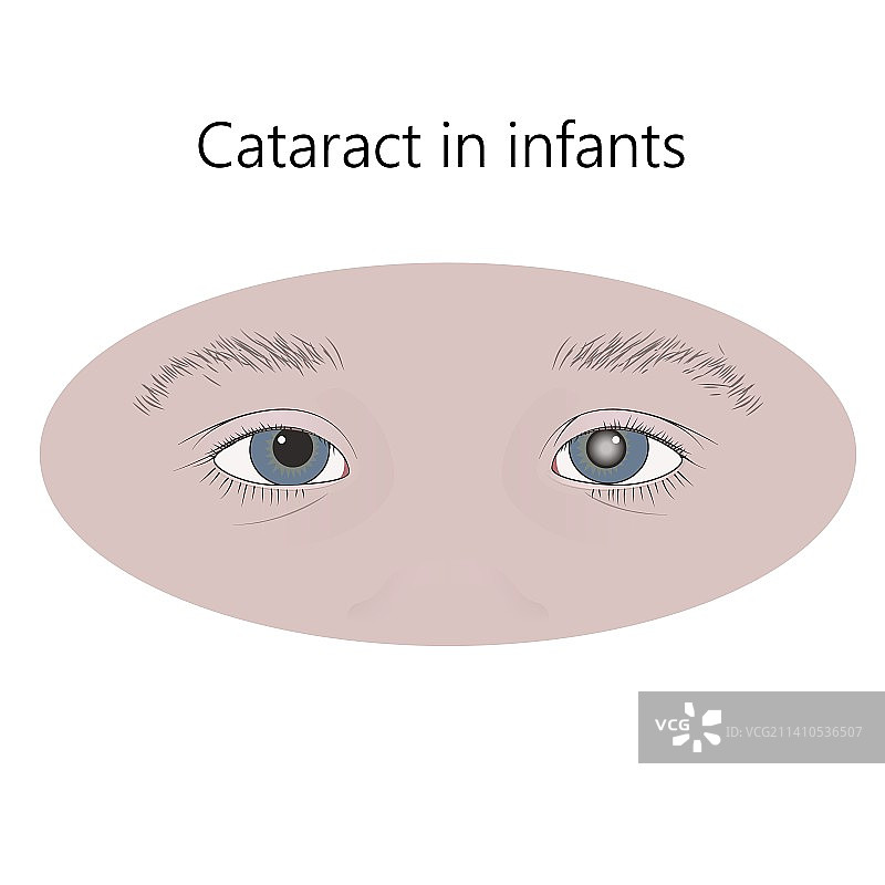 儿童白内障插图图片素材