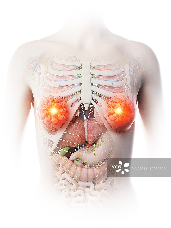 乳腺炎概念图图片素材