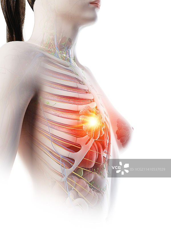 乳腺炎概念图图片素材