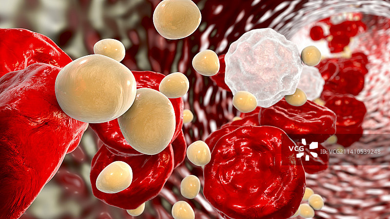 高胆固醇水平（图示）图片素材