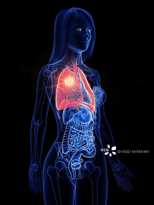 肺癌概念图图片素材