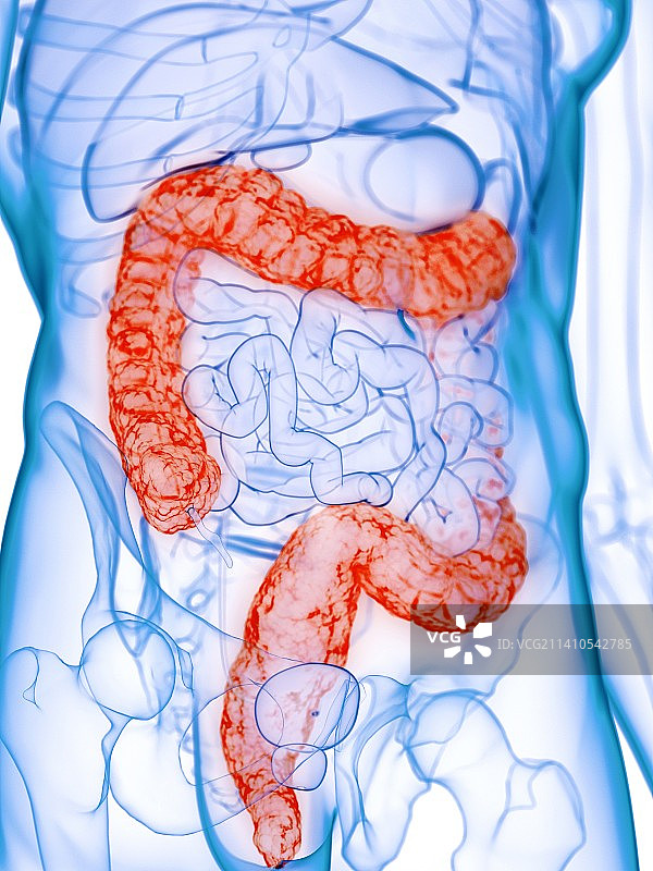 病变的结肠概念图图片素材