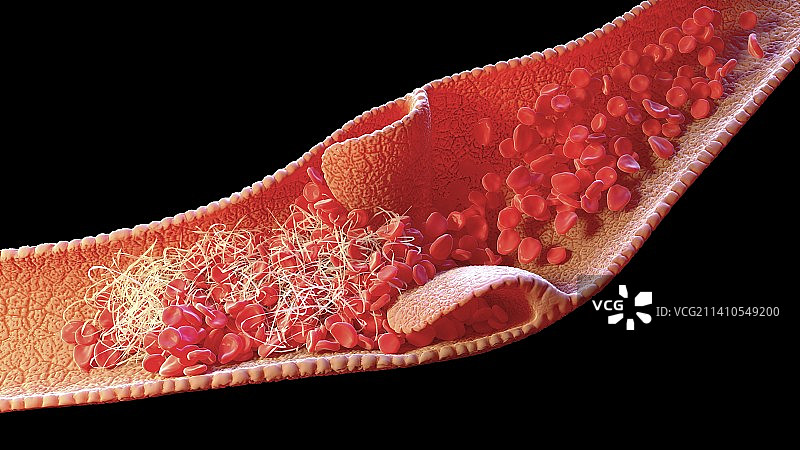 静脉内的血栓插图图片素材