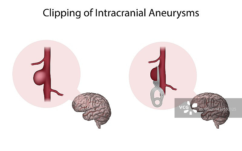 颅内动脉瘤夹闭术插图图片素材