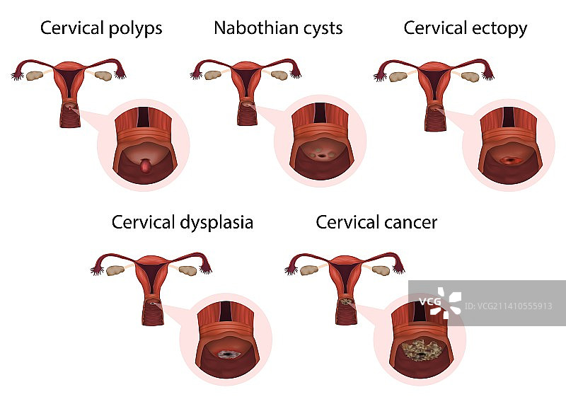 颈椎疾病插图图片素材