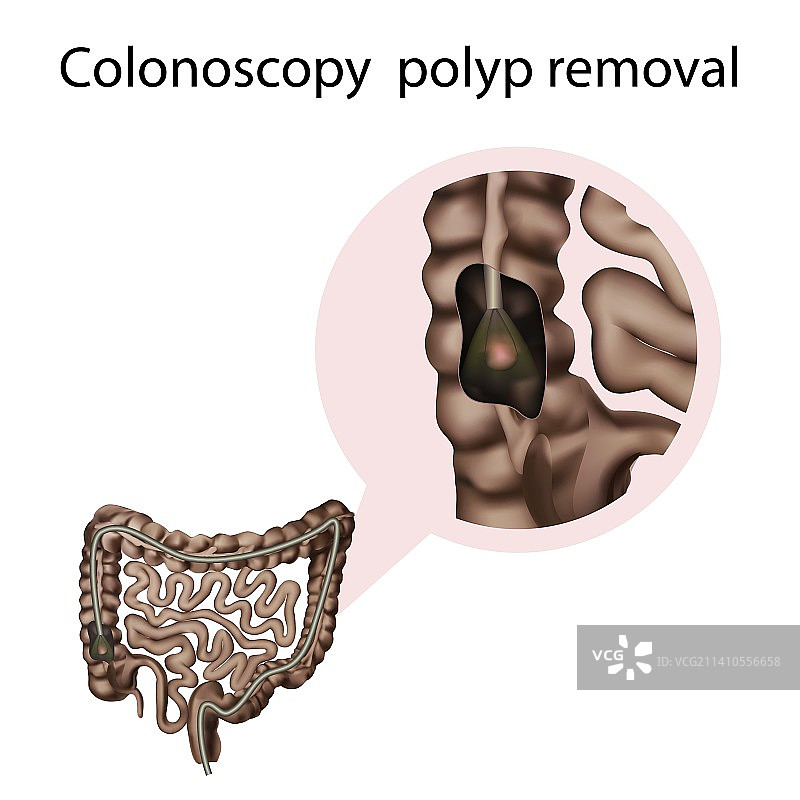 结肠镜息肉切除术，图示图片素材