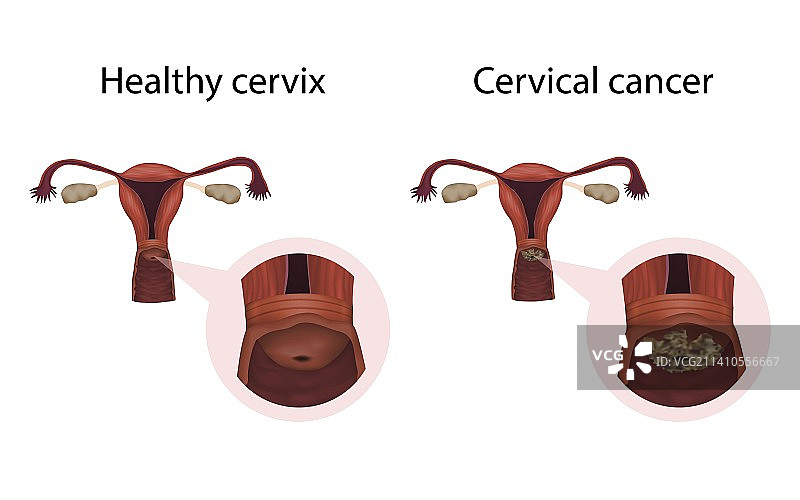 宫颈癌与健康宫颈图示图片素材
