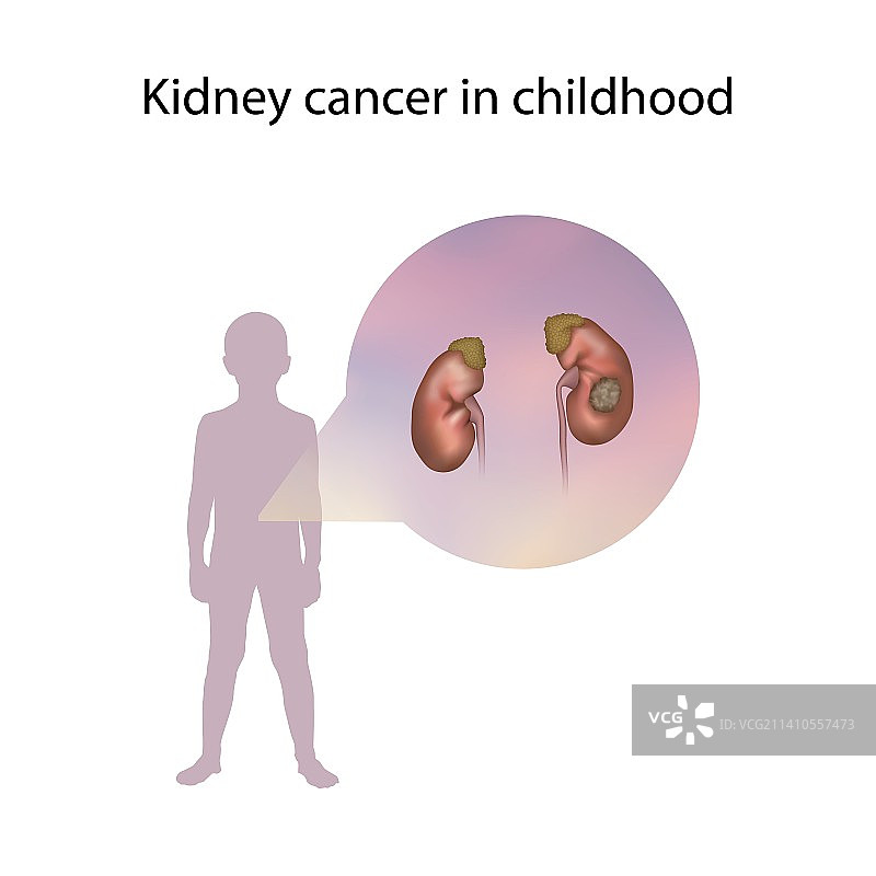 儿童肾癌插画图片素材