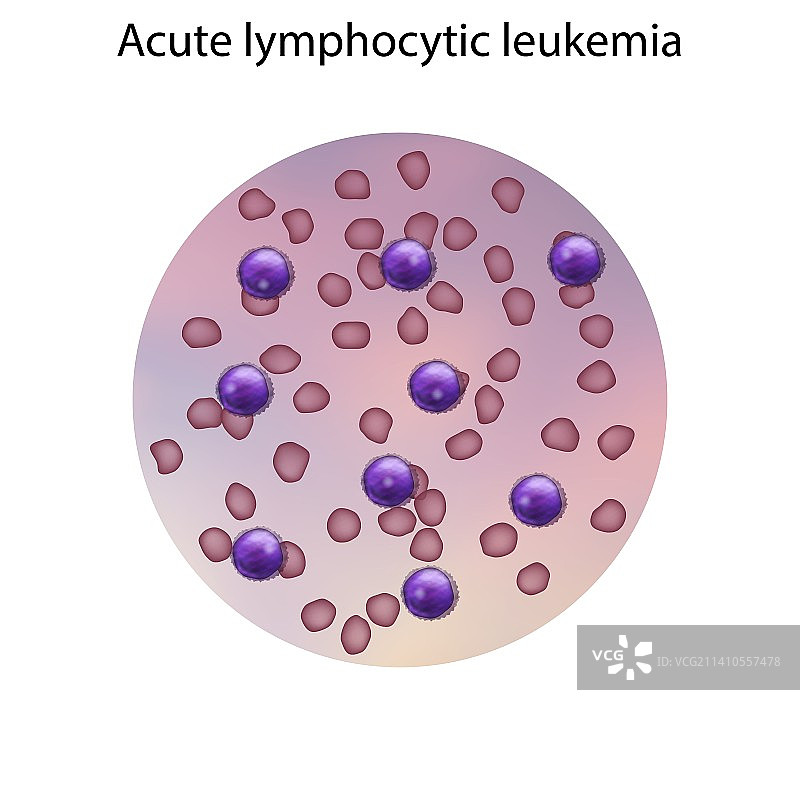 急性淋巴细胞白血病插图图片素材