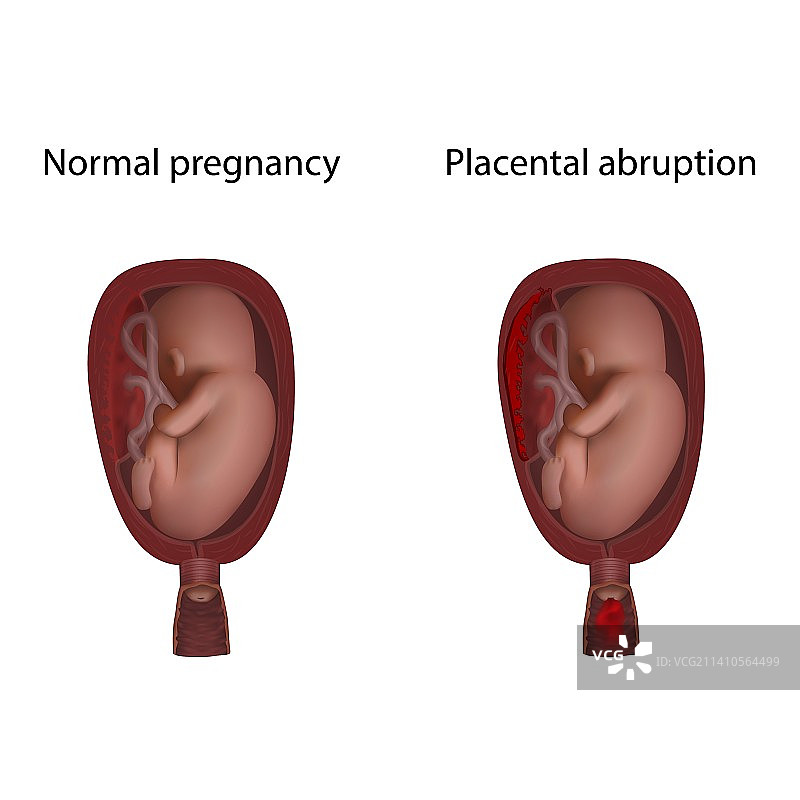 胎盘早剥与健康妊娠插图图片素材