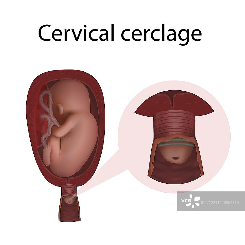 宫颈环扎术插图图片素材