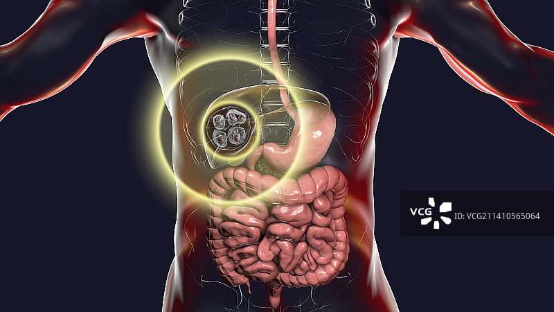 肝脏包虫病，泡型包虫病，图示图片素材