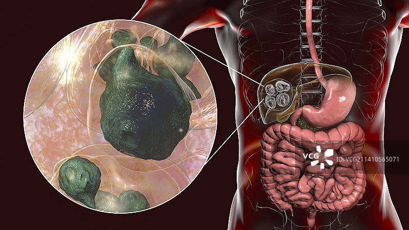 肝脏包虫病，泡型包虫病，图示图片素材