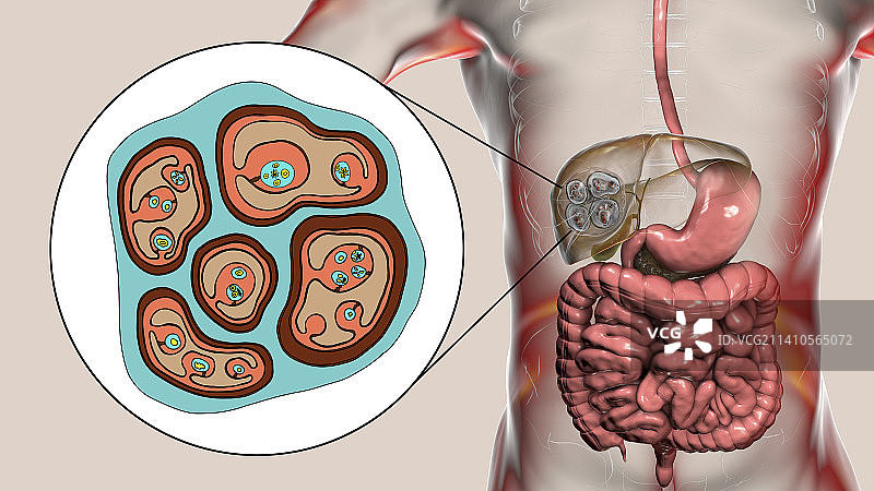 肝脏包虫病，泡型包虫病，图示图片素材