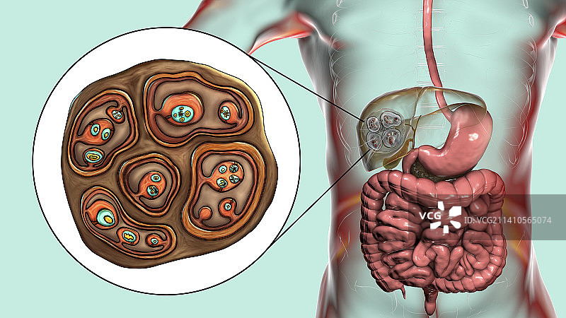 肝脏包虫病，泡型包虫病，图示图片素材