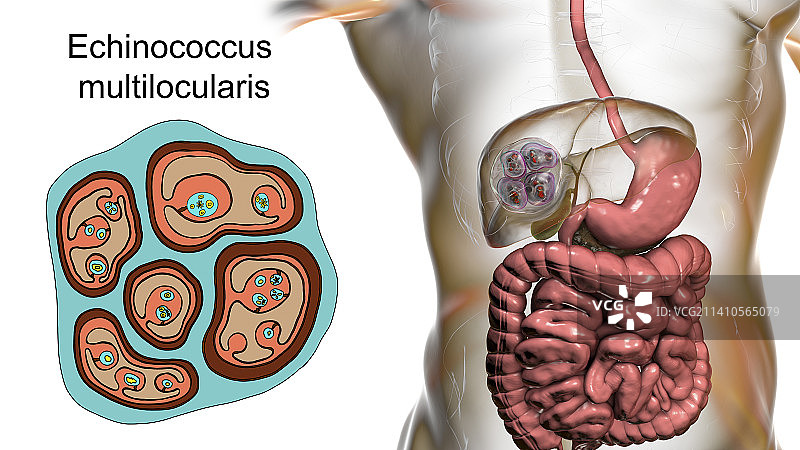 肝脏包虫病，泡型包虫病，图示图片素材